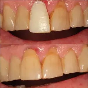 Friendship Custom Shade e.max Press Crown