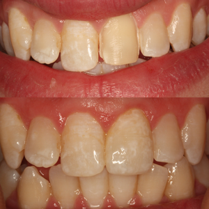 Friendship Custom Shade e.max Veneer