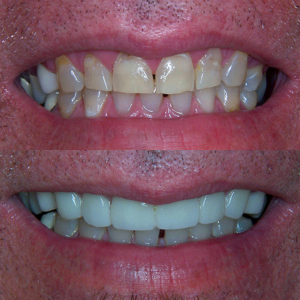Friendship Hollywood Smile e.max Crowns