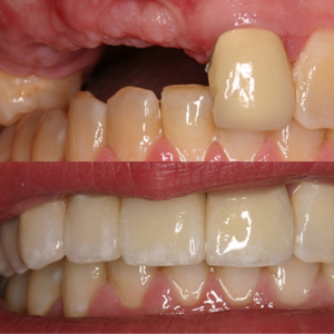 Friendship Implant Bridge e.max Press Crowns