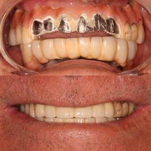 Friendship Implant Slip-Over Bridge Repair