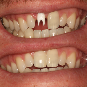 Friendship PFZ Crown on Zirconia Implant Abutment