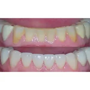 Friendship e.max Press Crowns