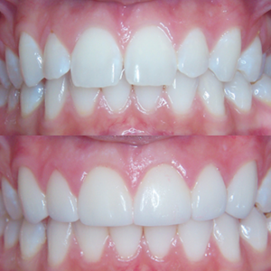 Friendship e.max Veneers
